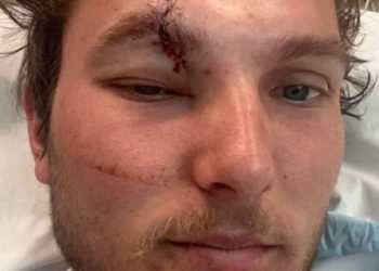 Ben ready to go again after scary chainsaw accident